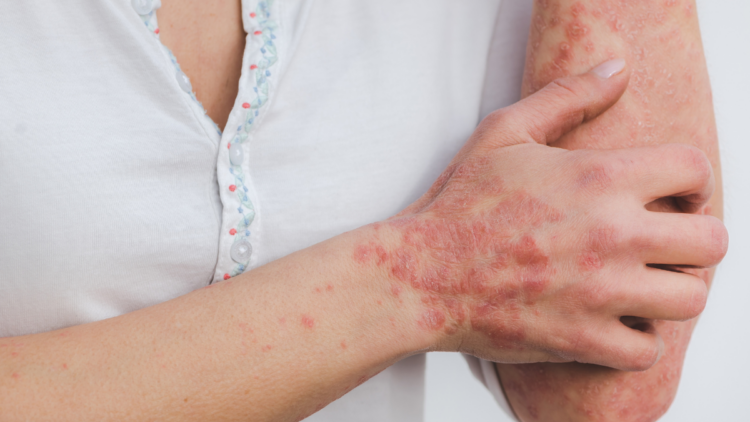 Anvisa autoriza novo medicamento biossimilar indicado para psoríase, artrite psoriásica, doença de Crohn e colite ulcerativa.