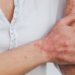 Anvisa autoriza novo medicamento biossimilar indicado para psoríase, artrite psoriásica, doença de Crohn e colite ulcerativa.