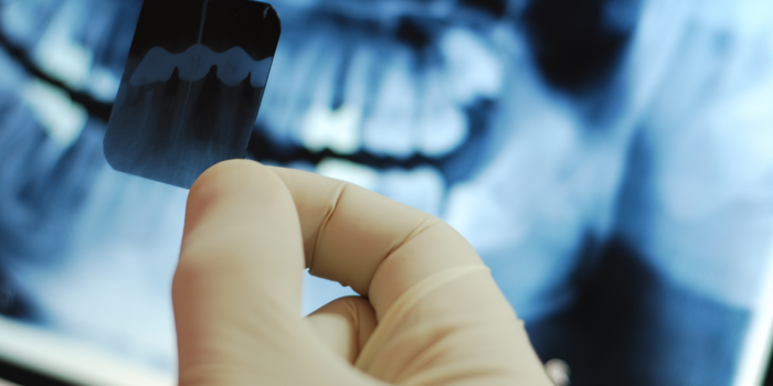 Pesquisadores da USP desenvolveram IA capaz de identificar dentes e detectar cáries em radiografias panorâmicas.
