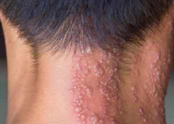 Vacina contra herpes-zóster poderá entrar no calendário do SUS se projeto aprovado em comissão do Senado concluir a tramitação no Congresso.