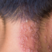 Vacina contra herpes-zóster poderá entrar no calendário do SUS se projeto aprovado em comissão do Senado concluir a tramitação no Congresso.
