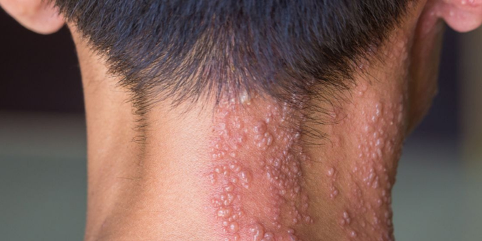 Vacina contra herpes-zóster poderá entrar no calendário do SUS se projeto aprovado em comissão do Senado concluir a tramitação no Congresso.