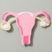 Planos de saúde terão cobertura obrigatória do DIU hormonal para pacientes com endometriose dentro dos critérios da ANS a partir de 1º de outubro.