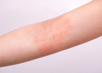 Entenda o que é inflamação tipo 2 e sua relação com asma, dermatite atópica, rinossinusite e outras doenças.