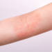 Entenda o que é inflamação tipo 2 e sua relação com asma, dermatite atópica, rinossinusite e outras doenças.