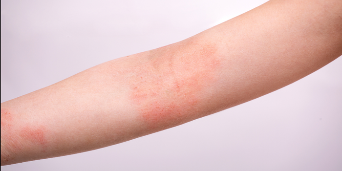 Entenda o que é inflamação tipo 2 e sua relação com asma, dermatite atópica, rinossinusite e outras doenças.